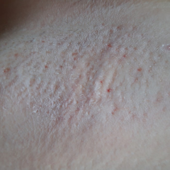 Депіляція воскова
                    Мастер депиляции  Киев