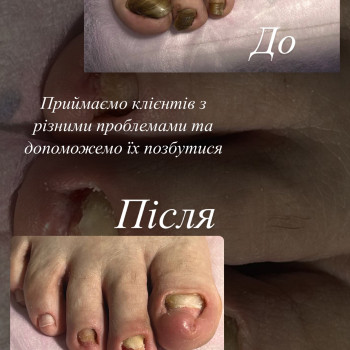 Грибкова інфекція, Фото до/після першої обробки.