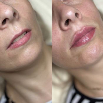 контурна пластика губ