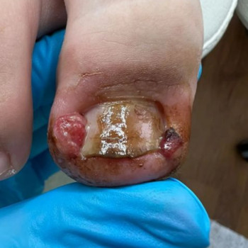 Первинне зняття больового синдрому при вростанні нігтьової пластини (перев‘язка 1-ша ступінь) консультація +план терапії
                    Подолог Лаура Киев