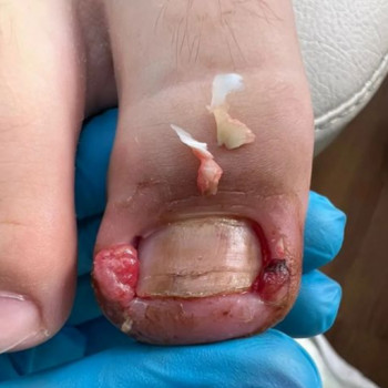 Первинне зняття больового синдрому при вростанні нігтьової пластини (перев‘язка 1-ша ступінь) консультація +план терапії
                    Подолог Лаура Киев