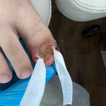 Первинне зняття больового синдрому при вростанні нігтьової пластини (перев‘язка 1-ша ступінь) консультація +план терапії
                    Подолог Лаура Киев