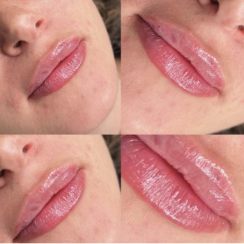 Збільшення губ, фото - Косметолог Алевтина Ісайченкова