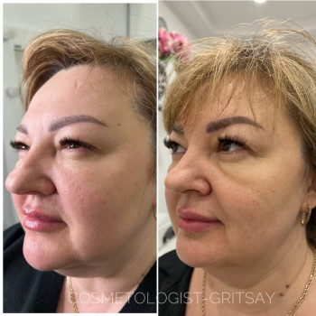 Курс із 6 процедур