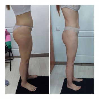 LPG Body Aesthetics, Бровари Фото - 45