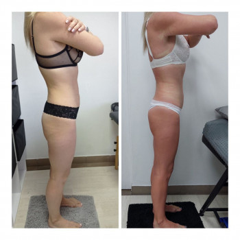 LPG Body Aesthetics, Бровари Фото - 52