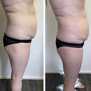 Зменшення підшкірно-жирової тканини