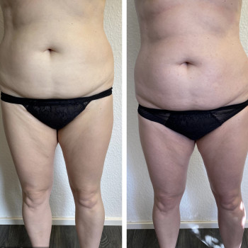 Покращився кровообіг, підвищився тонус шкіри.