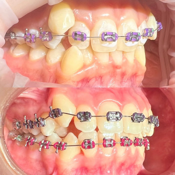 Фіксація брекет системи
                    Ортодонт Жанна Мельник Винница