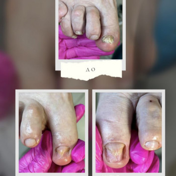 Фото из портфолио специалиста Татьяна Вакула (подолог, Харьков)