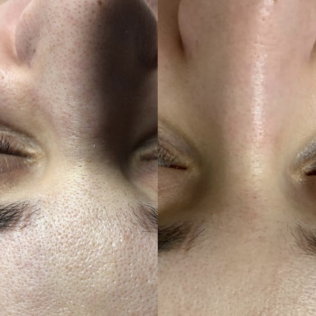 Результат чистки обличчя