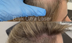 Прийом трихолога Медичний центр Bilyk - Ultra Laser Хмельницький