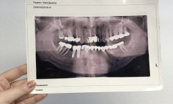 Панорамний рентген знімок зубів Стоматологічна клініка ВінСтом Вінниця