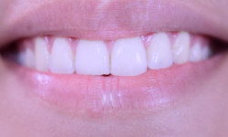 Протезування зубів у Вінниці Стоматологическая клиника ВінСтом Винница