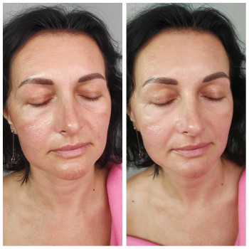 Гідропілінг
                    Косметолог Інга Хмельницкий