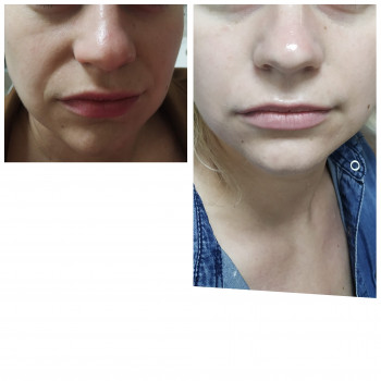 RF-ліфтинг (радиохвильовий ліфтинг)
                    Косметолог Інга Хмельницкий