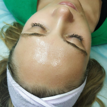 Поверхневі та серединні пілінги
                    Косметолог Інга Хмельницький