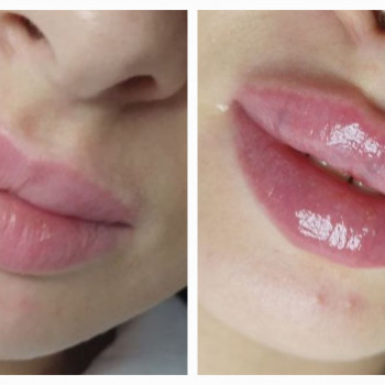 Аугументація губ
                    Косметолог-инъекционист Надежда Киев