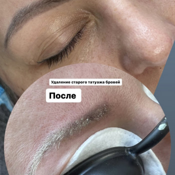 Видалення татуажу брів