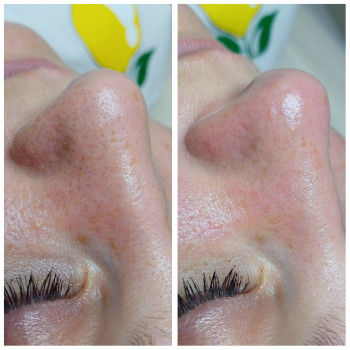 Гідропілінг
                    Косметолог Інга Хмельницкий