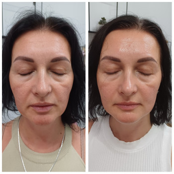 Фото до та після другого сеансу масажу