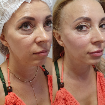 Контурна пластика скули
                    Лікар-косметолог Оксана Київ