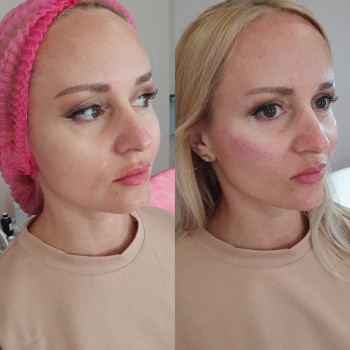 Контурна пластика скули
                    Лікар-косметолог Оксана Київ