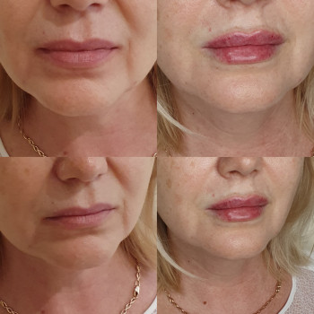 Процедура аугментації губ Швейцарським препаратом Genyal Pol