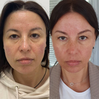 Біоревіталізація, пілінг, домашній догляд