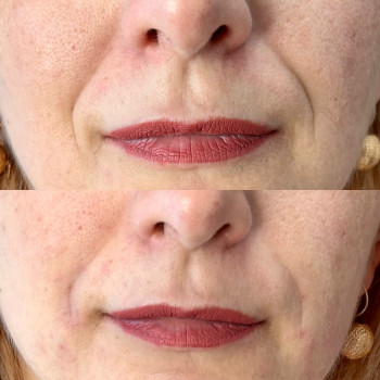 Коррекція носогубних складок
                    Косметолог-ін'єкціоніст Любов Запоріжжя