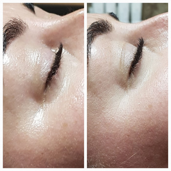 Фото до та після. Карбокситерапія після першої процедури.