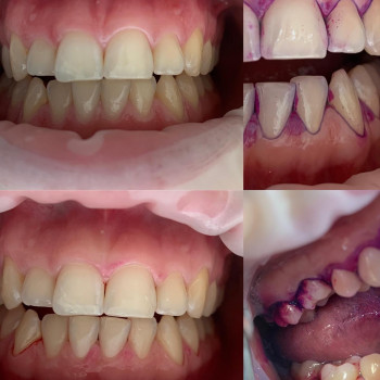 Професійна гігієна
                    Стоматологическая клиника  Винница