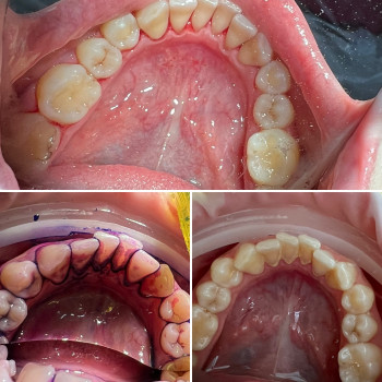 Зубний камінь - це мінералізований зубний наліт