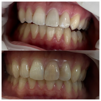 Дві керамічні реставрації які змінили посмішку