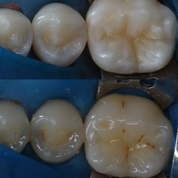 Композитні реставрації