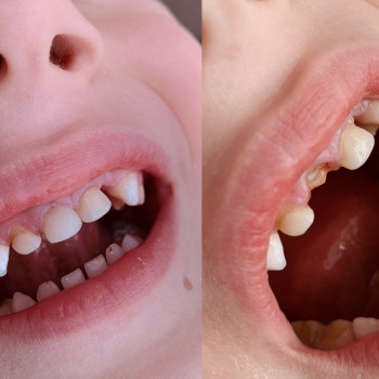 Нарощеня зуба дитині (всі зубки раніше були відновлені. пере