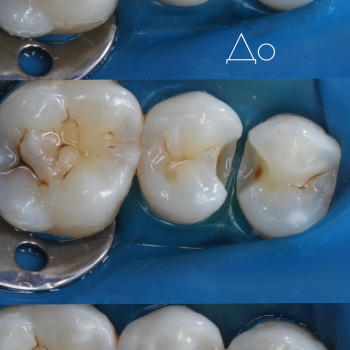 Лікування карієсу