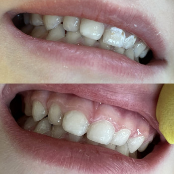 Реставрації зубів