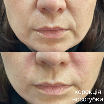 Контурна пластика обличчя
                    Косметолог Світлана Київ