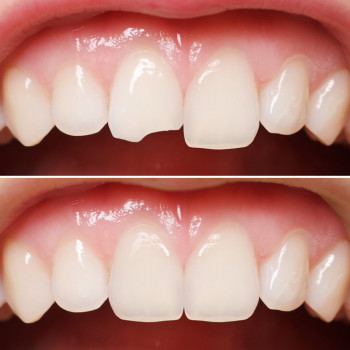 Реставрація сколу, фото - стоматолог Христина Товарянська