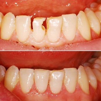 Відновлення нижнього центрального різця, фото - стоматолог Христина Товарянська