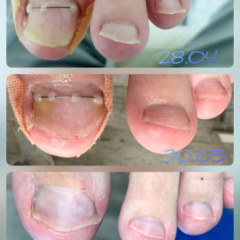   нігтів
  ногтей
 
  ніготь
  ноготь
 
  #