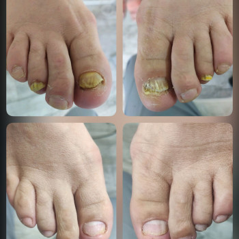   нігтів
  ногтей
 