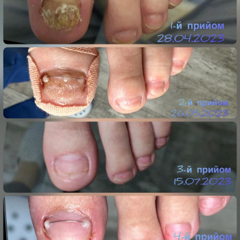   нігтів
  ногтей
 