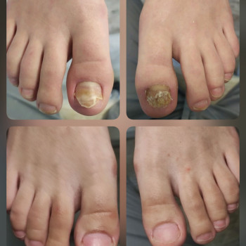   нігтів
  ногтей
 