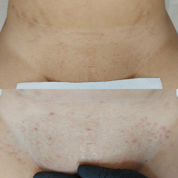 Результат після 3 процедур