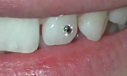 Встановлення прикраси на зуб Стоматолог  Львів