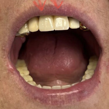 Коронки из диоксида циркония