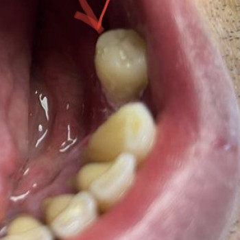 Коронка из циркония