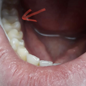 Фотополимерная пломба